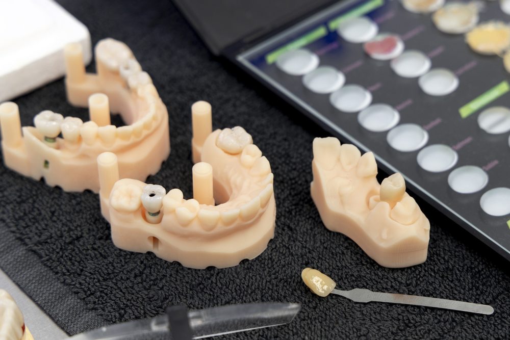 Dentist in Walnut Creek explaining dental implants vs bridges