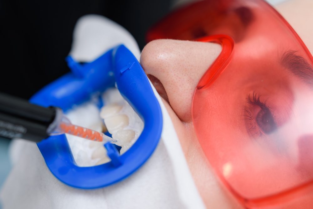 Professional teeth whitening treatment by a dentist in Walnut Creek